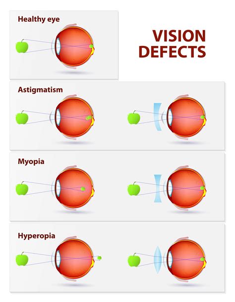 refraction test for vision issues